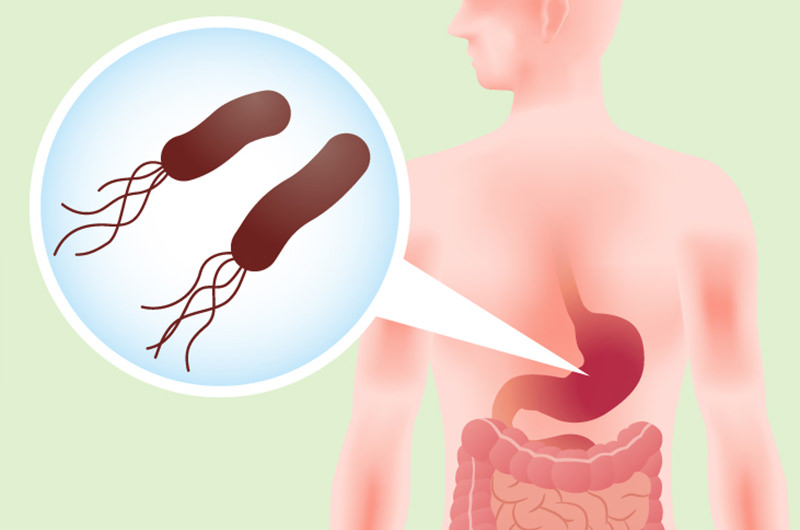 慢性胃炎のほとんどがピロリ菌の持続感染によるもの